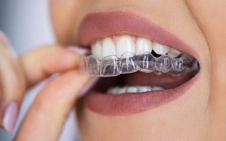Revolutionizing Dental Care: The Rise of Clear Aligners