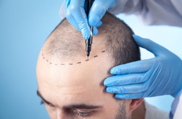 The Waiting Game: Determining The Optimal Window For Scalp Micropigmentation After Surgery