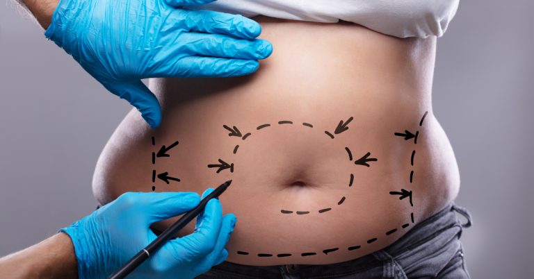 Say Goodbye to Belly Bulge: How An Abdominoplasty in Brisbane Can Help